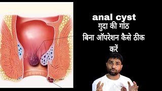 गुदा की गांठ में कैंसर कैसे हो जाता है #anal cyst treatment #fissuretreatment #fissure