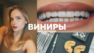 Поставила керамические виниры 🦷| моя история зубов