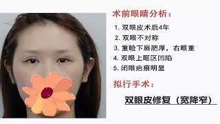 双眼皮修复 宽降窄