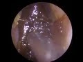 EARWAX REMOVAL SUCCESS AT HEAR4U