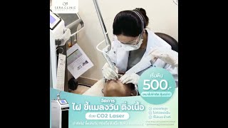 กำจัดไฝ ขี้แมลงวัน ติ่งเนื้อ สิวหิน ด้วยเลเซอร์ CO2 Laser ปลอดภัยสูง ไม่เกิดแผลเป็น l Sera Clinic