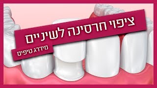 ציפוי חרסינה לשיניים -מתי עושים?