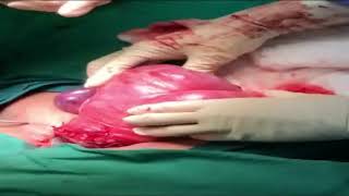 Uterine flexion suture for uterine atony  – Supplementary video [ID 170460]