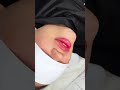 lips augmentation recommended рек top beauty aesthetic lifting lips skincare fullface