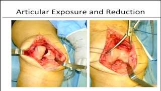 Surgical techniques for fixing complex distal femur fractures