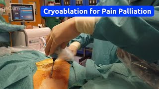 Palliative Cryoablation for Pain Management Using the ProSense™ System