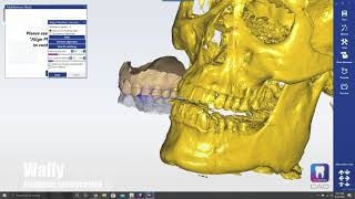 Condylar Inclination on CBCT