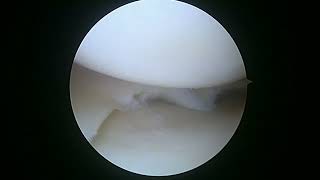 L Knee Partial medial menisectomy 10 17 22 AG AM