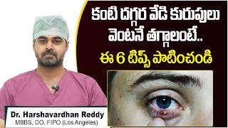 కంటి వేడి కురుపులు తగ్గాలంటే || Top 6 Tips to Get Rid of a Stye FAST || Smartvision Eye Hospitals