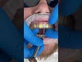 Predesigned composite veneers technique #dentist #shorts