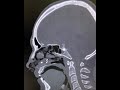 Shrapnel penetrating wound of the sphenoid sinus.Explosive injury.