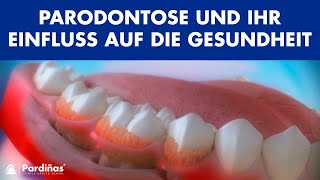 Parodontose und ihr Einfluss auf die Gesundheit ©