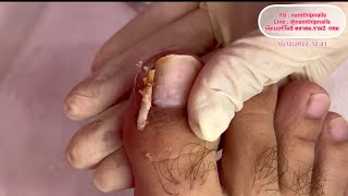 Ep.368 : ingrown toenails removal ความเจ็บที่แอบซ่อนอยู่ใต้หนัง ดูเหมือนไม่เป็นอะไร