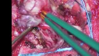 the surgery for removal of parasagittal meningioma