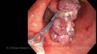 Colonoscopic Polyp Removal | Dr. Chirayu Chokshi | Aadicura Superspeciality Hospital Vadodara