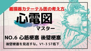 【心電図】No.6 心筋梗塞 後壁梗塞 V1-3 ST低下 ミラーイメージ