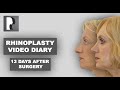 Rhinoplasty video diary – 13 days after surgery (13/14)