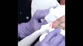 Large Blackheads Extraction Big Cystic Acne Blackheads\u0026Whiteheads Removal Pimple Popping #160#Shorts