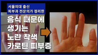 얼굴, 손바닥, 발바닥이 노랗게 변하는 '카로틴 피부증'