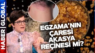 Sedef ve Egzamaya Çare! Akasya Reçinesi Tedavisi Nedir Nasıl Uygulanır? Reyhan Aliusta Anlattı