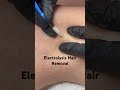 Electrolysis Hair Removal