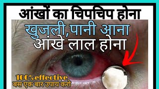 आंखों का चिपचिप होना,खुजली,लाल होना या पानी आने को चुटकियों में सही करे Dry Eye Syndrom||Eyes care