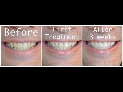 How-to Whiten your teeth with Hydrogen Peroxide How-to Whiten your teeth with Hydrogen Peroxide