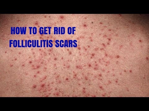 HOW TO GET RID OF FOLLICULITIS SCARS HOW TO GET RID OF FOLLICULITIS SCARS