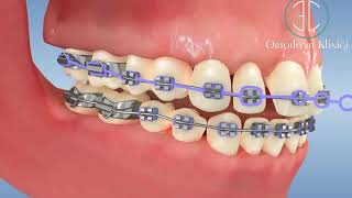 Sabit Ortodontik Tedavide Dişler Arası Boşlukların Kapatılması