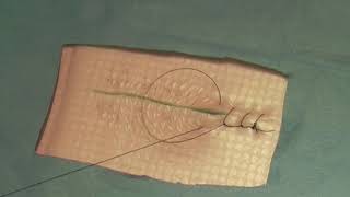 Ford Interlocking Suture Pattern