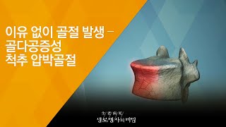 이유 없이 골절 발생 – 골다공증성 척추 압박골절 - (20180725_656회 방송) 허리 노화에 맞서라