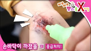 삐뽀삐뽀! 우리 몸 X파일 - 손바닥이 까졌어요_#001