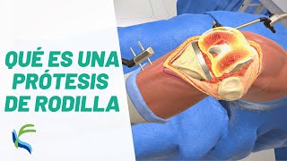 Que es una PROTESIS de RODILLA - Cirugia y Recuperacion | Fisiolution