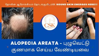 puluvettu poga tips, alopeciaAREATA poga best vali, alopeciaAREATA Dr advice, புழுவெட்டு மறைய டிப்ஸ்