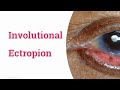 Involutional Ectropion