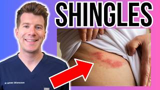 Doctor explains Shingles | Causes, rash, treatment, vaccine and more