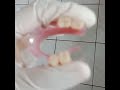 Valplast Flexible Denture