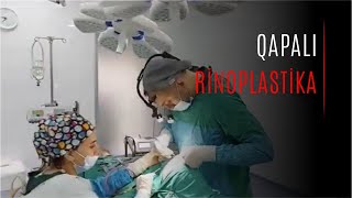 Qapalı rinoplastika