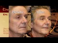 Chin/Cheek Enhancement Las Vegas: Patient Testimonial Joseph