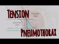 the basics treating tension pneumothorax