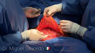 Verticalization and umbilicalization of neo-onphaloplaty in the classical abdominoplasty/Dr. Miguel