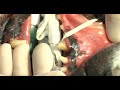 iM3 Inc. - Surgical Tooth Extraction