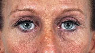 Upper Eyelid Rejuvenation with Fat Grafting