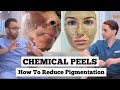 Chemical Peels for Pigmentation | Best Chemical Peel Treatments with Dr. Somji & Dr. Solomon!