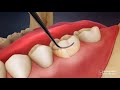 Video Tutorial: Dental Scaling