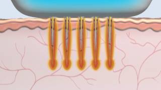 Animation Radiofréquence MicroNeedle Secret