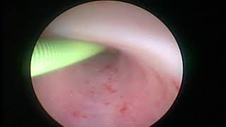 Ureteroscopic removal of Ureteral calculi ( by soloscope)   (Unedited Original Video)