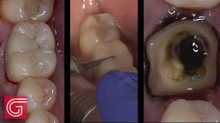 How to Remove an Old emax Crown on a Lower Molar