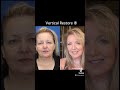 JAW-DROPPING Facelift Transformation!