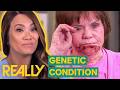 Neurofibromatosis Treated By Dr. Sandra Lee Changes Patient's Life | Dr. Pimple Popper